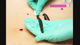 روشهای افزایش گیرایی زالو