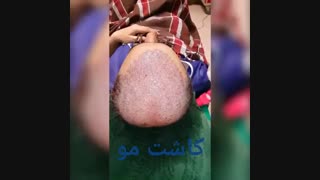 کاشت مو - دکتر ابدالی - 22807060