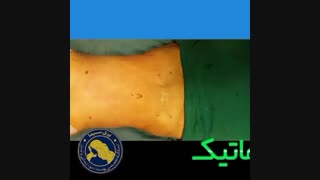 لیپوماتیک - دکتر ابدالی - 22807060