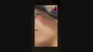 برداشت خال - دکتر صفیه چعباوی زاده رفع افتادگی پلک