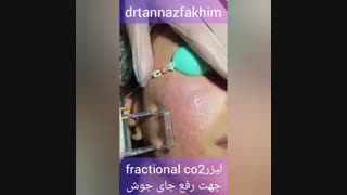 لیزر co2 fractional جهت رفع جای جوش برداشتن خال گوشتی