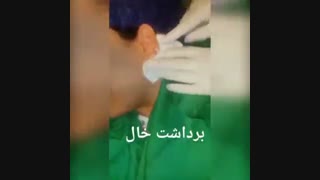 برداشت خال - دکتر ابدالی - 22807060