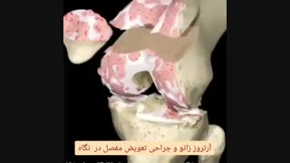 آرتروز و عمل تعویض مفصل زانو
