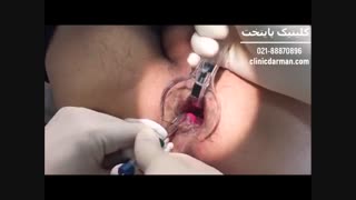 درمان قطعی بواسیر یا هموروئید با لیزر - پایتخت