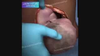 انیمیشن نحوه انجام سزارین