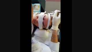 کاشت ابرو طبیعی | کلینیک لیان | 02188978829