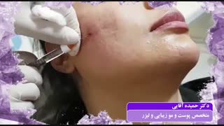 تزریق ژل گونه با کانولا ارتودنسی