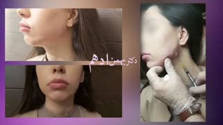 تزریق ژل برای زاویه دار کردن فک