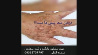 اگزما چیست و چگونه درمان می شود؟؟