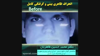 انحراف ظاهری بینی و گرفتگی کامل