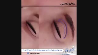 بلفاروپلاستی