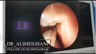 جراحی آندوسکوپی بینی