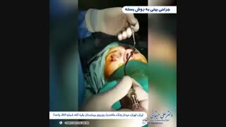 جراحی بینی به روش بسته
