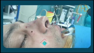 فیلم جراحی پولیپ بینی