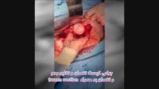 جراحی کیست تخمدان و تخلیه رحم