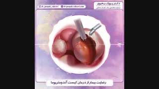 رضایت بیمار از درمان کیست آندومتریوما