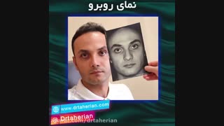 نتیجه عمل زیبایی بینی بعد از شش ماه