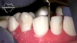 میزان تراش دندان در لمینیت سرامیکی | دندانستان