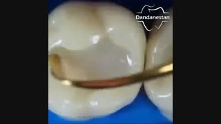 پر کردن دندان با کامپوزیت | دندانستان