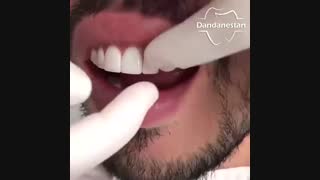 ونیر دندان | دندانستان