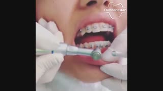 بهداشت دهان و دندان در ارتودنسی | دندانستان