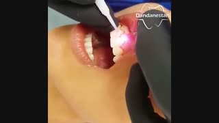 بالا بردن خط لثه با لیزر | دندانستان