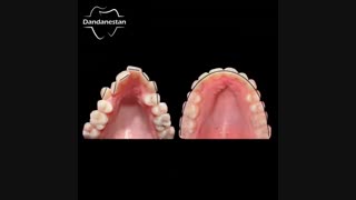 درمان تنگی فک بالا با استفاده از سیستم دیمون | دندانستان