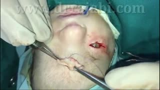 جراحی کریپتوفتالموس یا ایجاد پلک