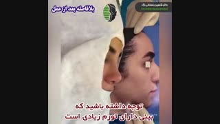 جراحی بینی استخوانی