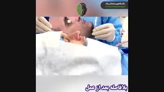عمل بینی طبیعی