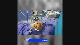 تزریق فیلر به گونه همزمان با جراحی بینی | دکتر شهریار یحیوی