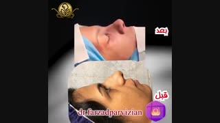 فیلم جراحی زیبایی بینی همراه با عمل انحراف بینی