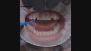 لمینیت دندان | دندانستان