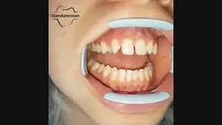 لمینت دندان | دندانستان