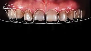 اصلاح طرح لبخند | دندانستان