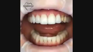 لمینیت دندان | دندانستان