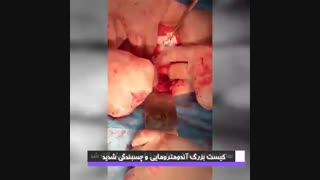 کیست بزرگ آندومترومایی و چسبندگی شدید