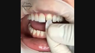 لمینت دندان | دندانستان
