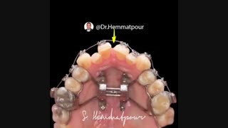 درمان تنگی فک بالا | دندانستان