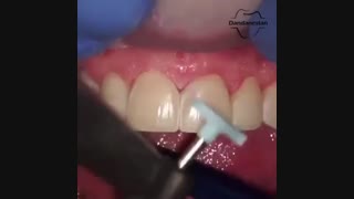 پالیش دندان | دندانستان