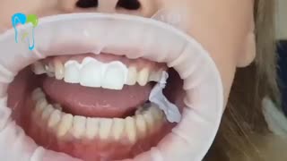 اصلاح طرح لبخند | دندانستان