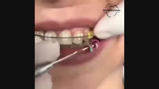 کش رنگی ارتودنسی | دندانستان