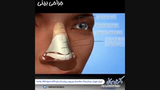 جراحی بینی