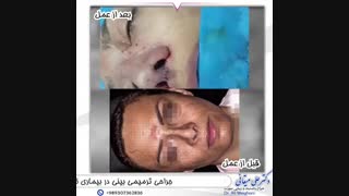 جراحی ترمیمی بینی
