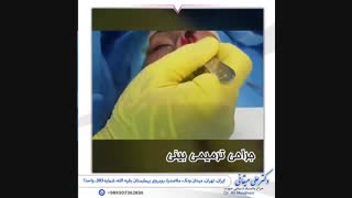 جراحی ترمیمی بینی