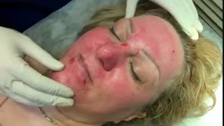 میکرونیدلینگ برای جوانسازی پوست دندانپزشک زیبایی