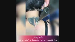 فیلم پاک کردن تاتو با لیزر کیوسوییچ دندان مصنوعی