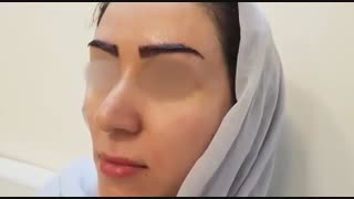علل کاشت ابرو
