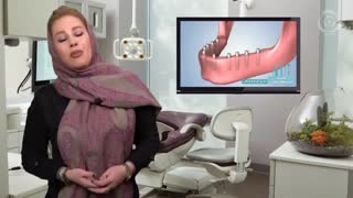 ایمپلنت دندان- مزایا و معایب ایمپلنت