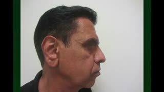 لیفت پیشانی و اابرو کلینیک دندانپزشکی